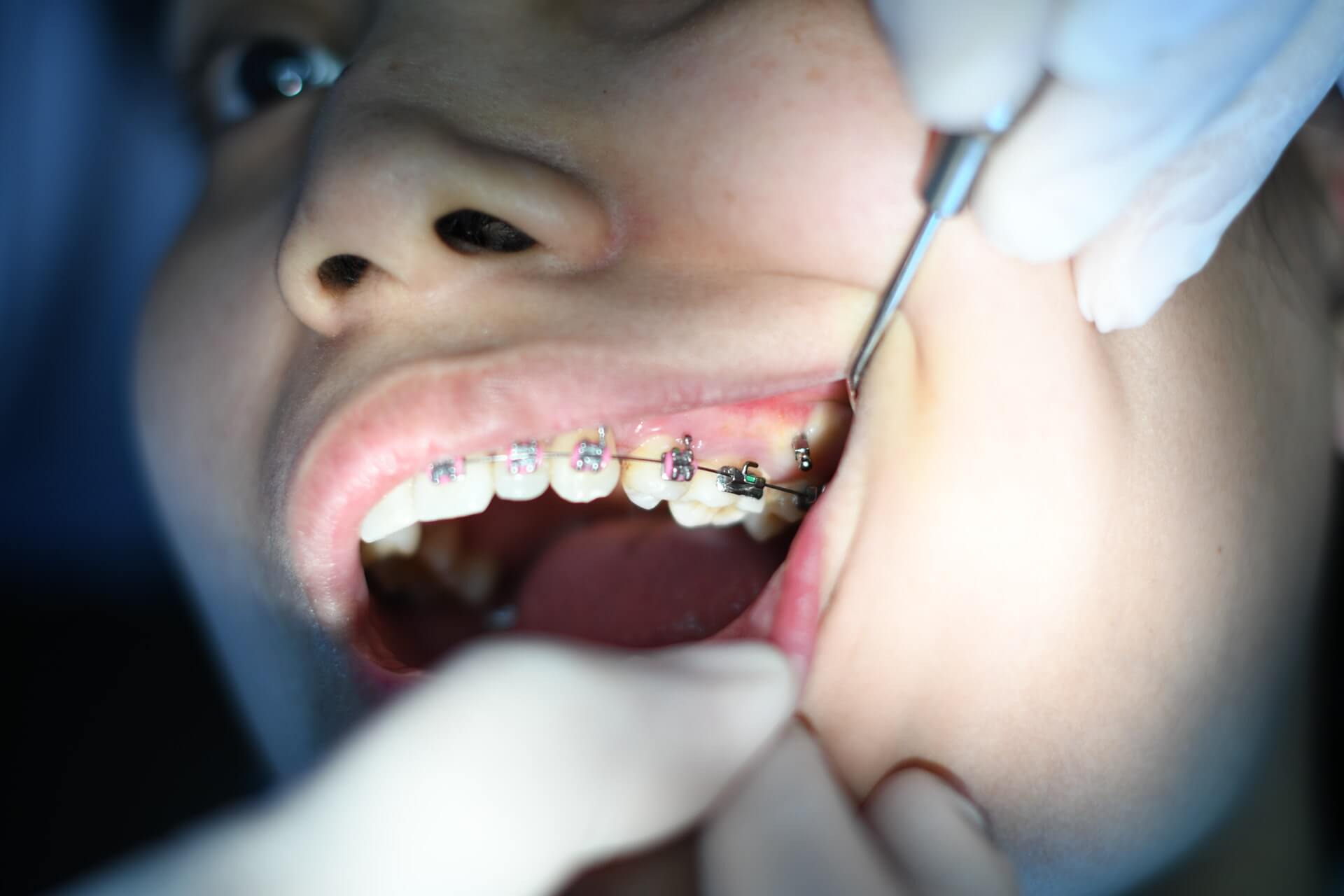 Leczenie ortodontyczne dzieci