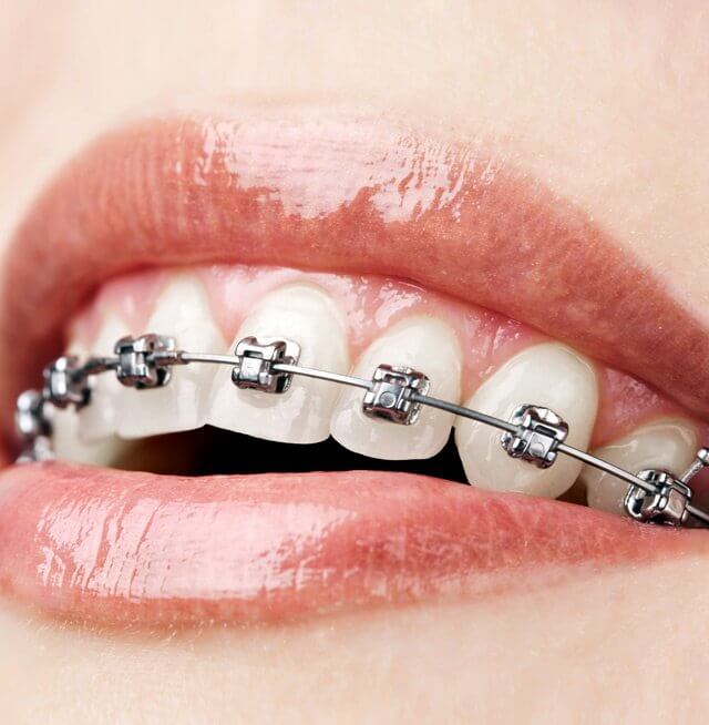 poznań ortodonta aparat na zębach piękny uśmiech